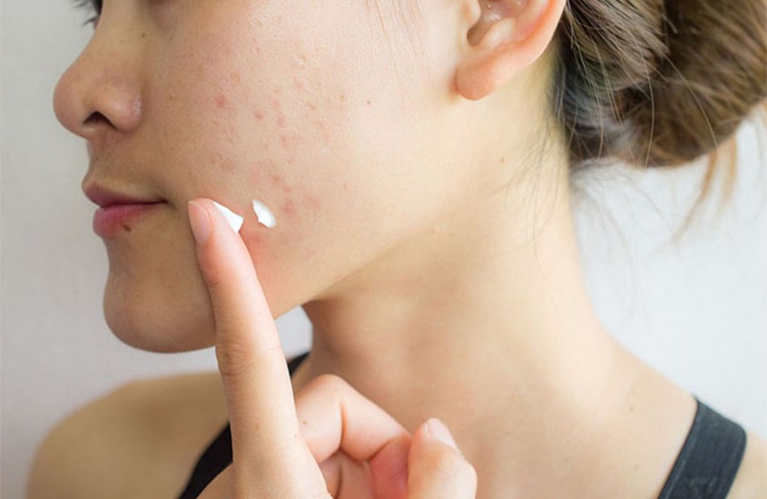 Việc bôi kem chấm mụn trước hay sau serum sẽ phụ thuộc vào tình trạng da của bạn.