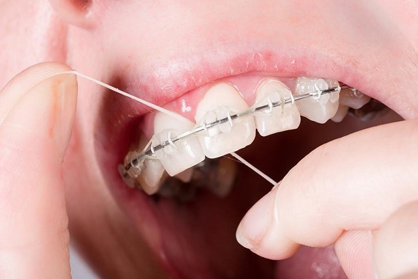 dùng chỉ nha khoa