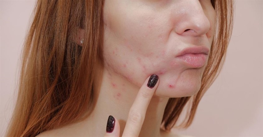 Nguy cơ gây kích ứng, làm tổn thương da