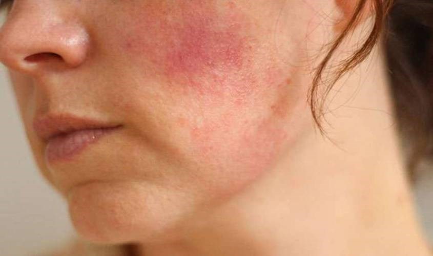 Tinh dầu có thể gây kích ứng, ngộ độc và dị ứng.