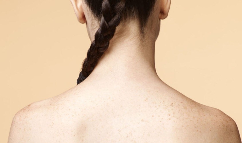 Giúp ngăn ngừa tình trạng mụn cơ thể