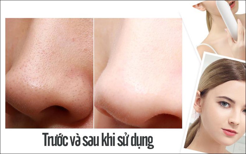 Khác biệt trước và sau khi hút mụn