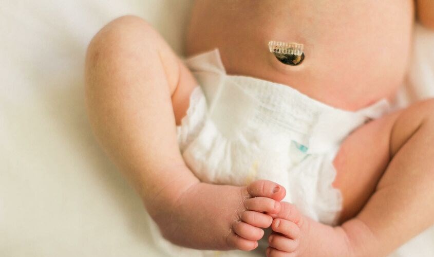 Lưu ý khi đóng bỉm cho bé chưa rụng rốn