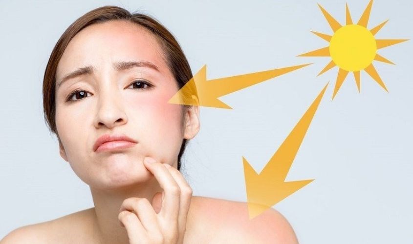 Sữa  tươi không đường giúp làm dịu làn da cháy nắng