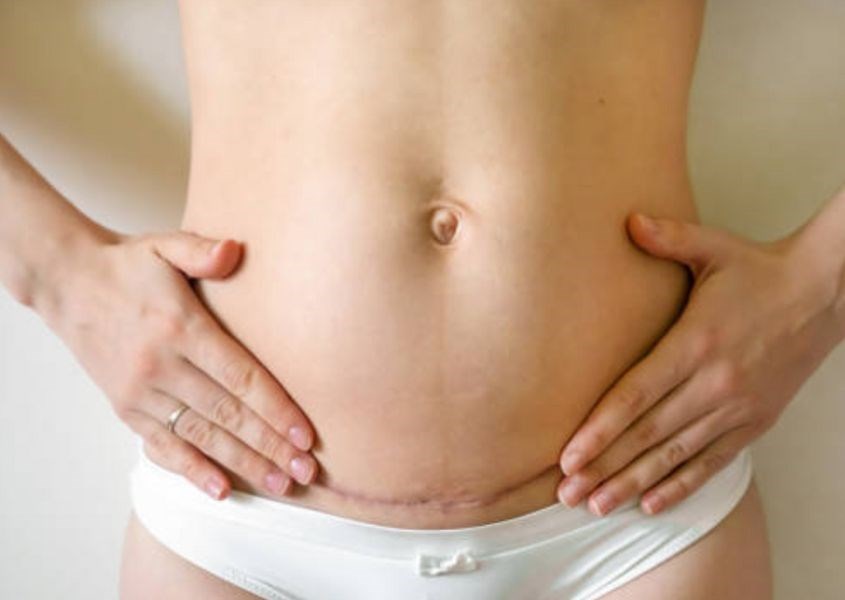 Những điều bạn cần biết nếu mang thai lần 2 sau khi sinh mổ