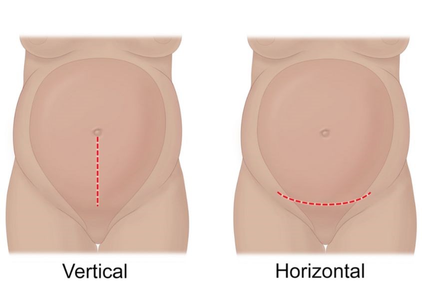 Có 2 kiểu phẫu thuật để lấy thai nhi là mổ theo chiều dọc và mổ theo chiều ngang
