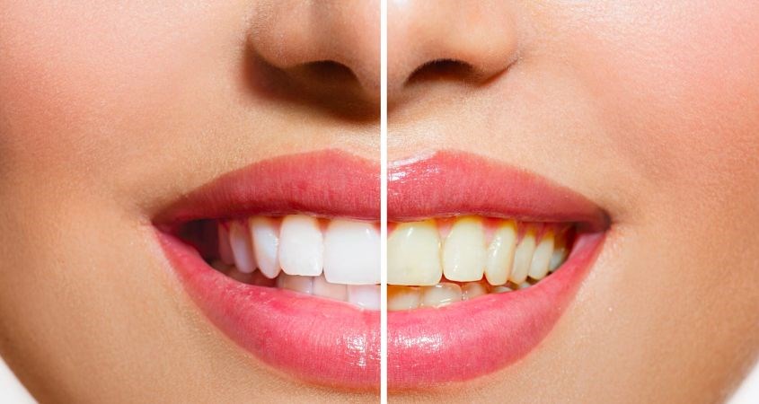 Cấp ẩm cho khoang miệng tránh tình trạng lở loét lợi