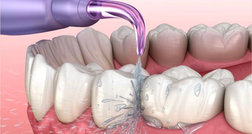Đừng quên dùng máy tăm nước làm sạch kẽ răng, bề mặt răng