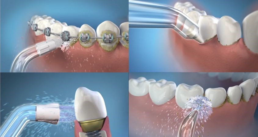 Dễ sử dụng đặc biệt với người đang trong quá trình niềng răng