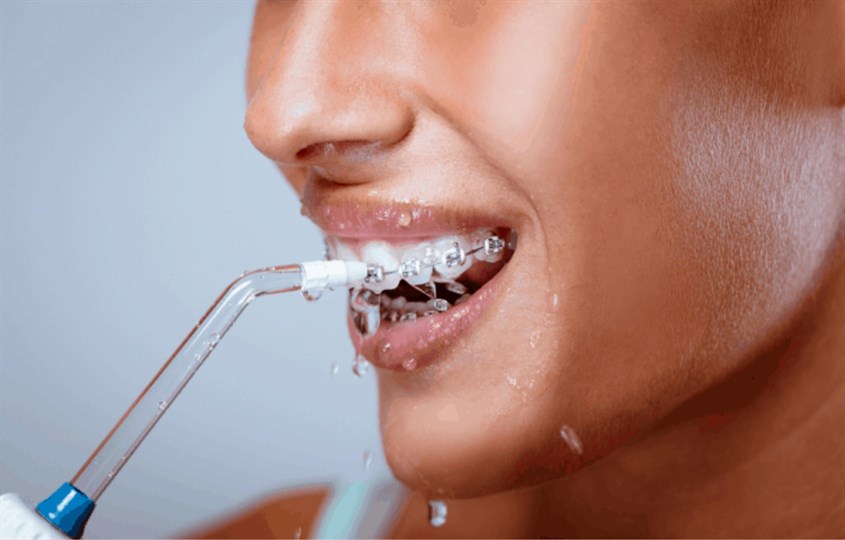 Hiệu quả với việc vệ sinh răng niềng