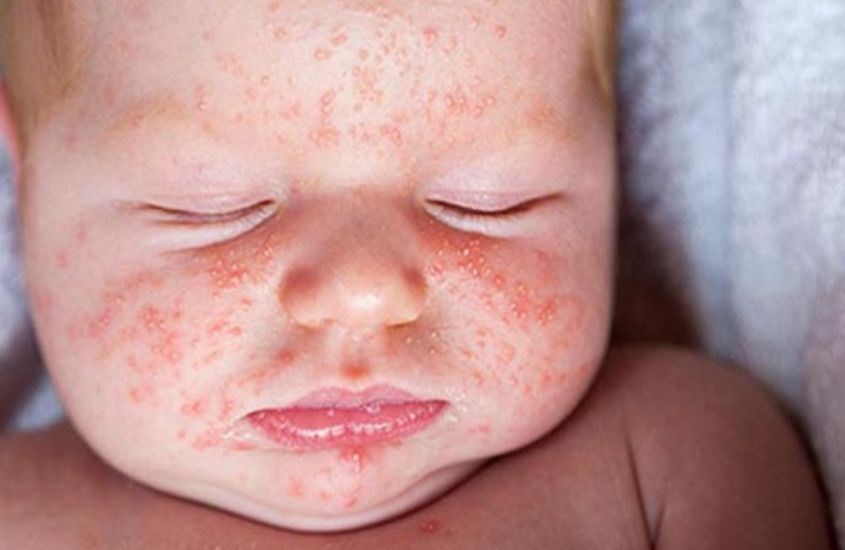 Trẻ dị ứng đạm sữa bò nặng cần được khám bác sĩ sớm để tránh nguy hiểm