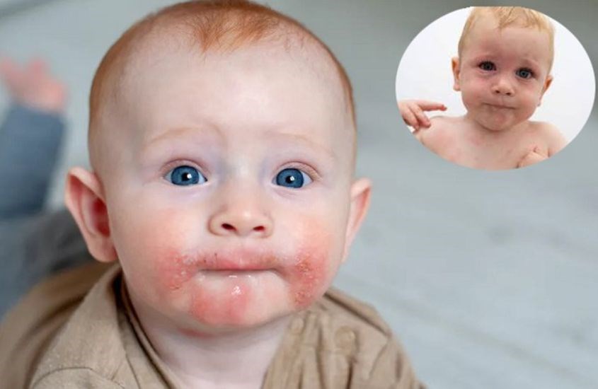 Nổi mề đay là một trong những triệu chứng của dị ứng đạm sữa bò