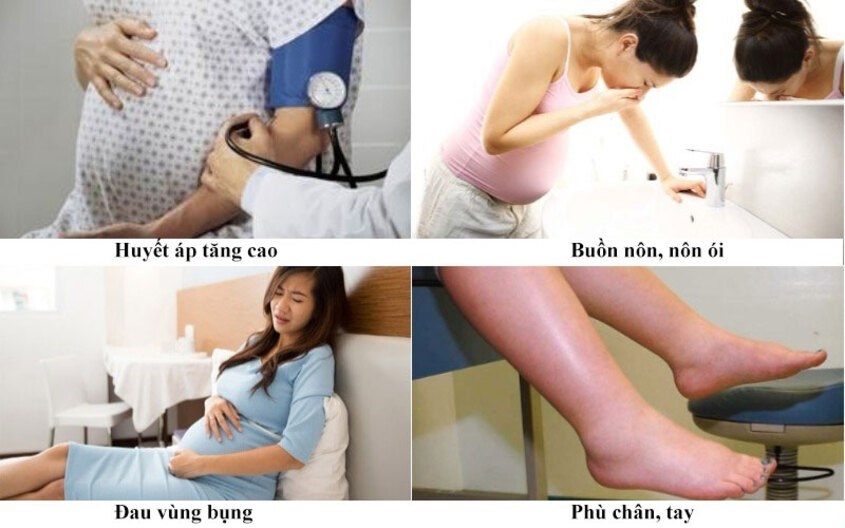 Các triệu chứng tiền sản giật Các triệu chứng tiền sản giật