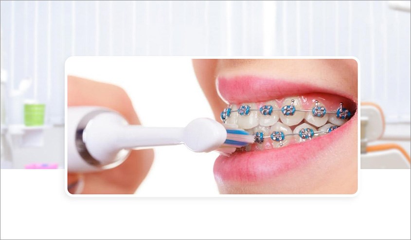 Cần đánh đúng vị trí và đúng cách để tránh ảnh hưởng đến mắc cài và nướu