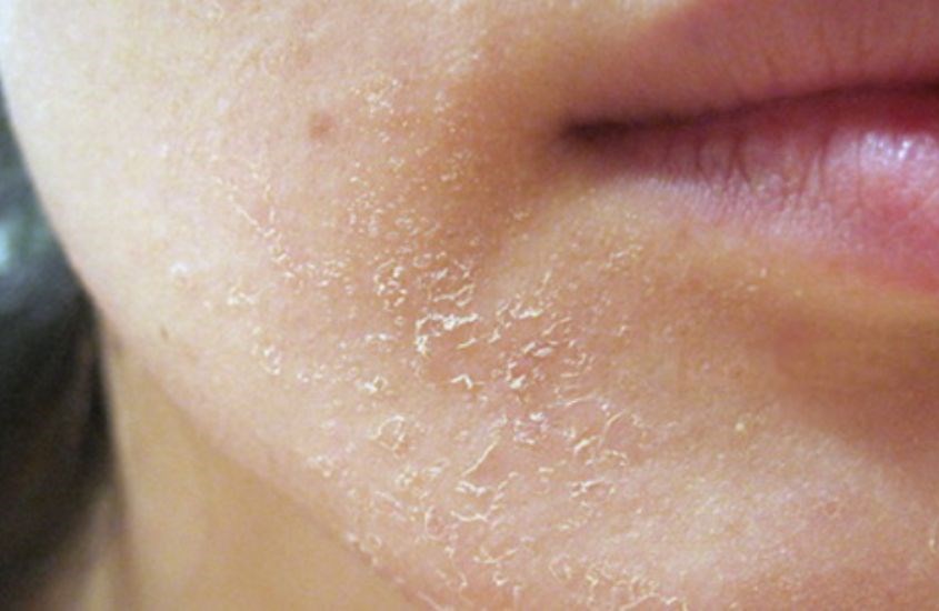 Da khô nên chọn sữa rửa mặt dạng kem (cream)