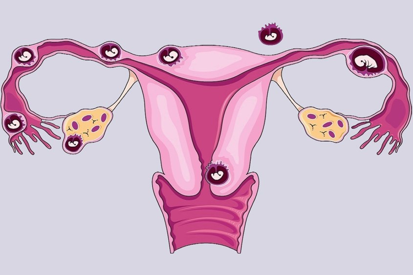 Thai ngoài tử cung là một trong những nguyên nhân khiến Hcg tăng cao