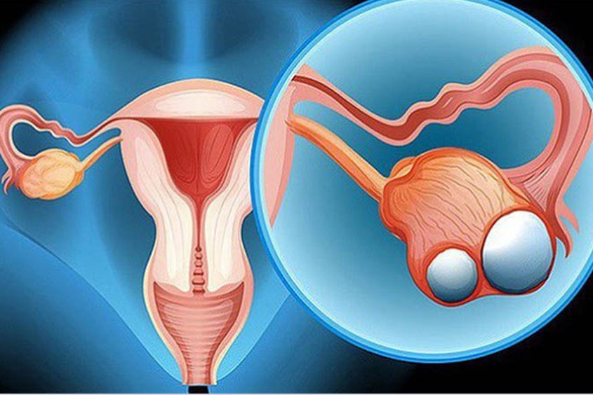 U tế bào mầm cũng khiến cho Hcg tăng cao