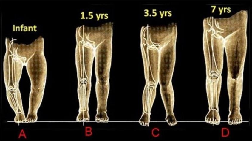 Hình ảnh cong chân sinh lý theo từng độ tuổi. Nguồn ảnh: Báo Tuổi trẻ