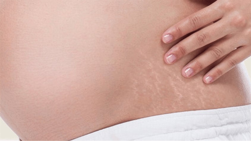 Các vết rạn da khi mang thai trên mỗi người sẽ có màu sắc khác nhau, chúng phụ thuộc vào màu da của bạn