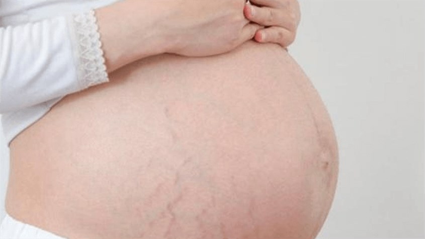 Những vết rạn da khi mang thai thường khó để loại bỏ hoàn toàn