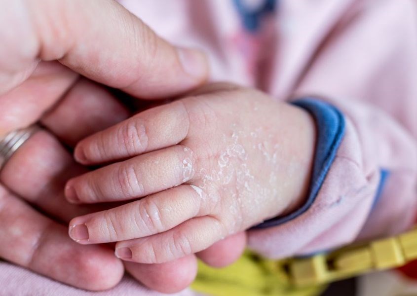 Khô da là một tình trạng khá phổ biến ở trẻ khi thời tiết lạnh. Nguồn từ babymore