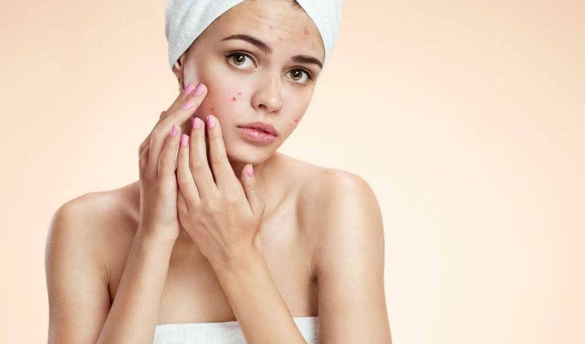 Nên vệ sinh, chăm sóc da đúng cách để ngăn ngừa mụn