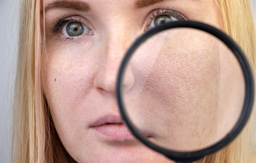 Tình trạng lỗ chân lông to