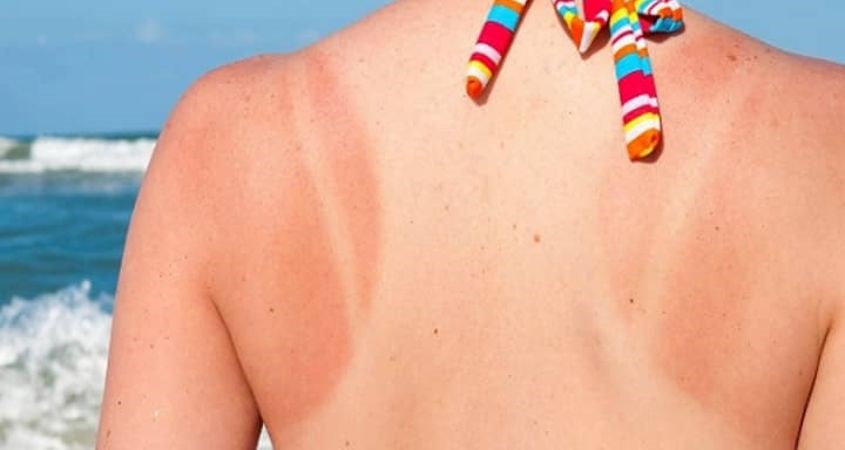 Ngăn ngừa cháy nắng, rám nắng khi dùng kem chống nắng 