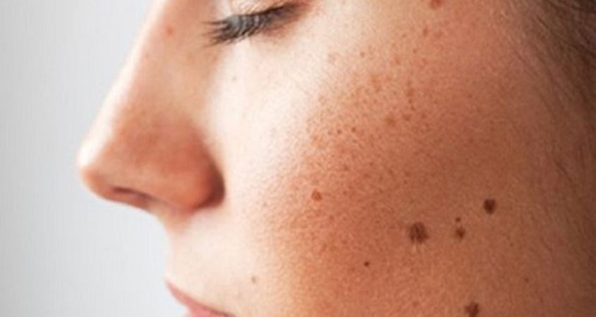 Giảm nguy cơ ung thư da 