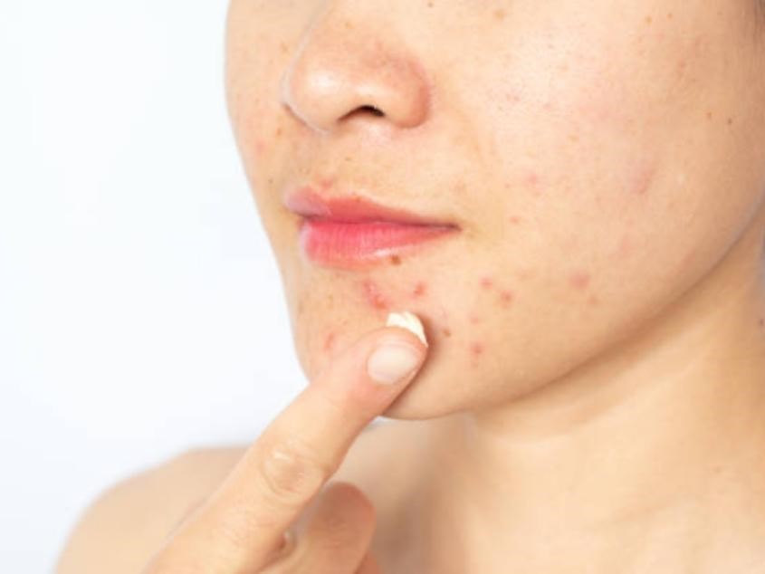 Mẹ bầu nên sử dụng ít kem trị mụn và chỉ bôi lên những vùng bị ảnh hưởng. Nguồn: Getty Images. Mẹ bầu nên sử dụng ít kem trị mụn và chỉ bôi lên những vùng bị ảnh hưởng. Nguồn: Getty Images.