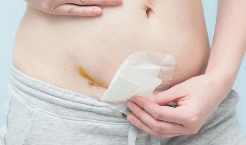 Vệ sinh vết mổ đúng cách. Nguồn ảnh: freepik