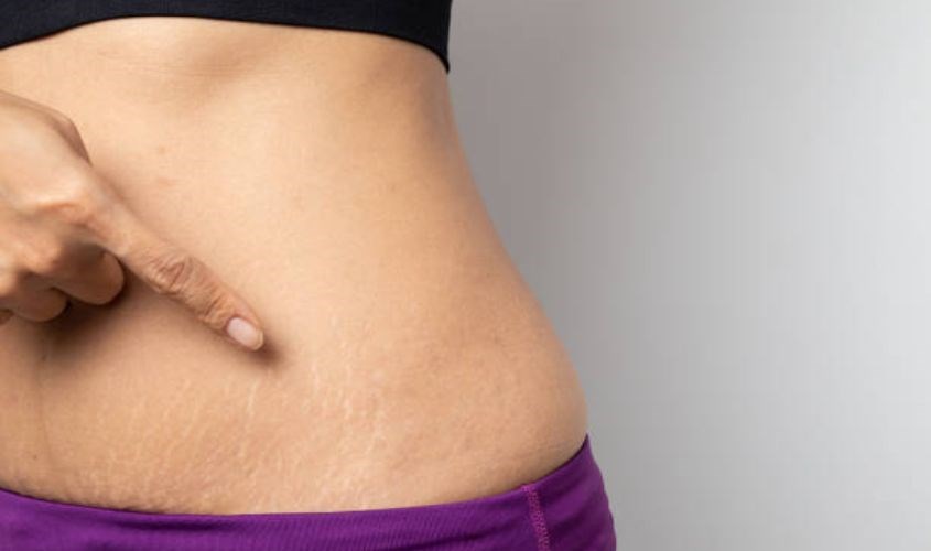 Mang thai cũng làm cho làn da của thai phụ căng ra, có thể dẫn đến mất nước và độ ẩm. Nguồn: iStock