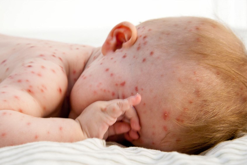 Mẹ bầu mắc thủy đậu có thể khiến trẻ bị nhiễm thủy đậu sơ sinh