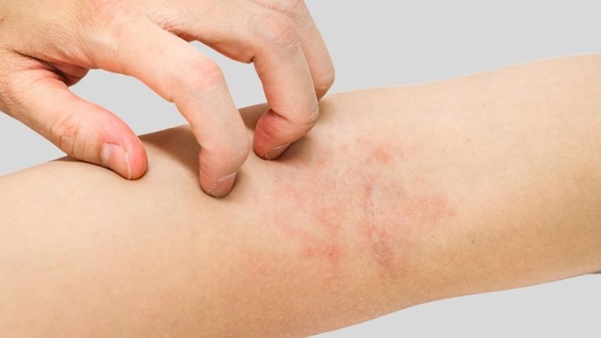 Da có thể bị ngứa rát sau khi triệt lông