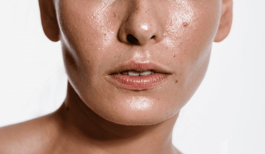 Làn da dầu rất dễ bị bít tắc, nổi mụn Làn da dầu rất dễ bị bít tắc, nổi mụn