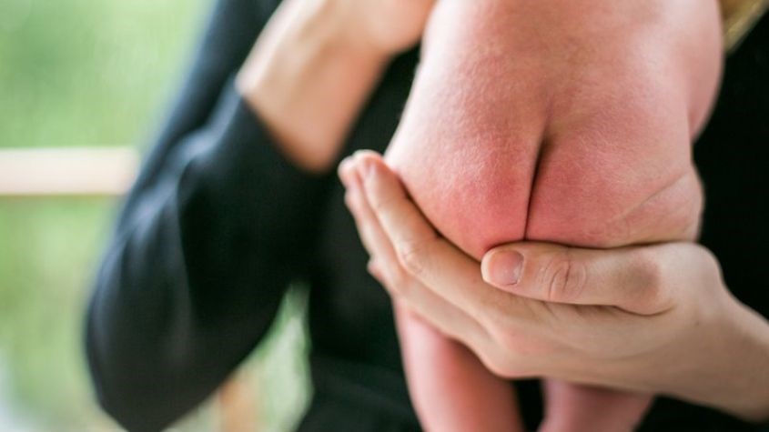 Bé có thể bị hăm tã do nhiều nguyên nhân