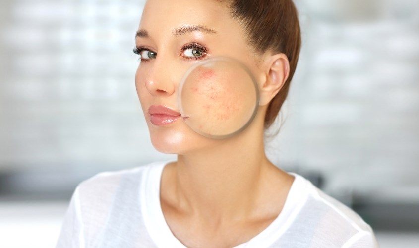 Massage mặt có thể giảm mụn trứng cá trên da