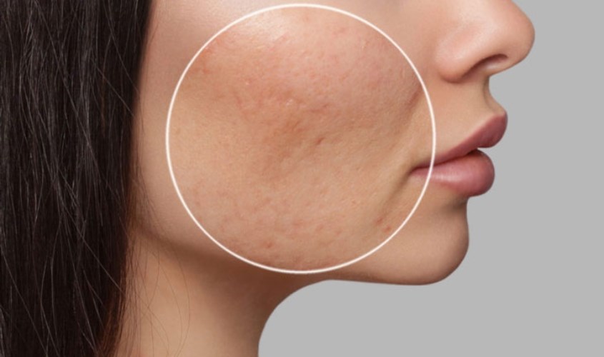 Massage mặt hỗ trợ quá trình liền sẹo