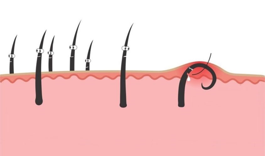 Cạo râu sai hướng dễ khiến râu mọc ngược