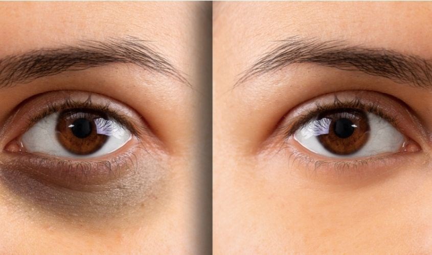 Mặt nạ mắt giúp giảm quần thăm mắt