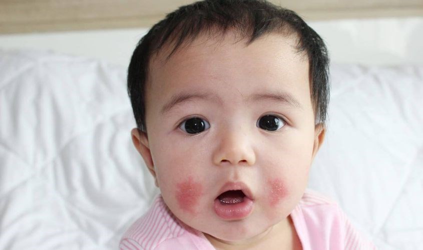 Cách xử lý khi trẻ bị dị ứng thức ăn bố mẹ cần biết!