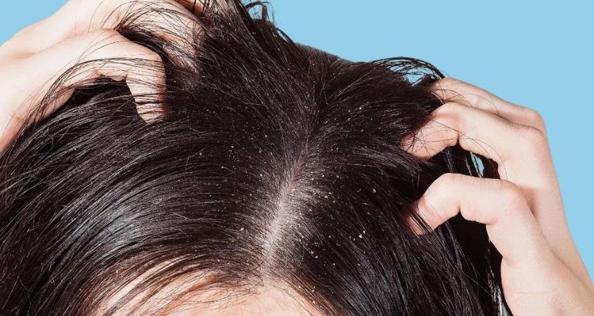 Review chi tiết 7 loại dầu gội bye bye tóc bết tóc xẹp sát vào da dầu