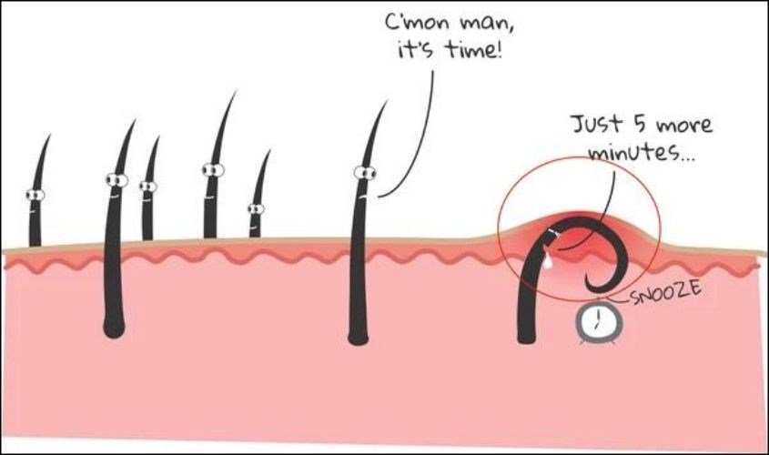 Nhổ lông mũi gây ra tình trạng lông mọc ngược