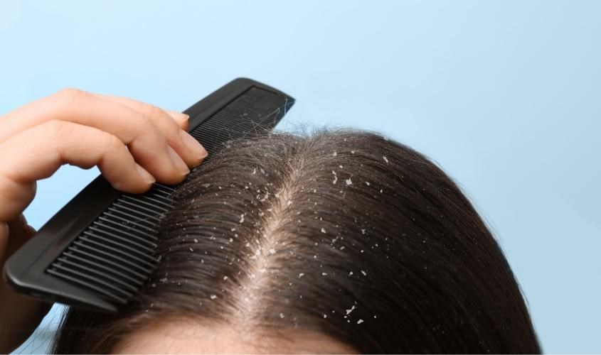 Ủ tóc bằng sữa chua giúp làm sạch gàu