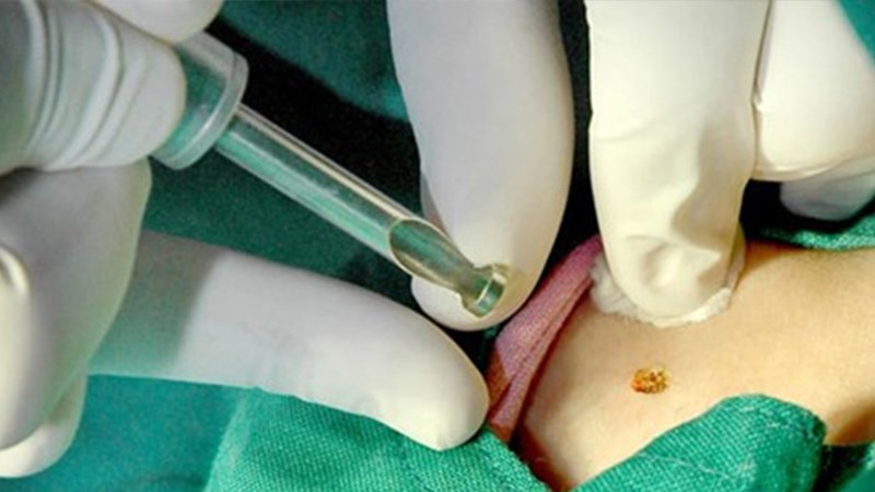 Sử dụng laser là một trong những phương pháp được sử dụng để điều trị mụn cóc bàn chân