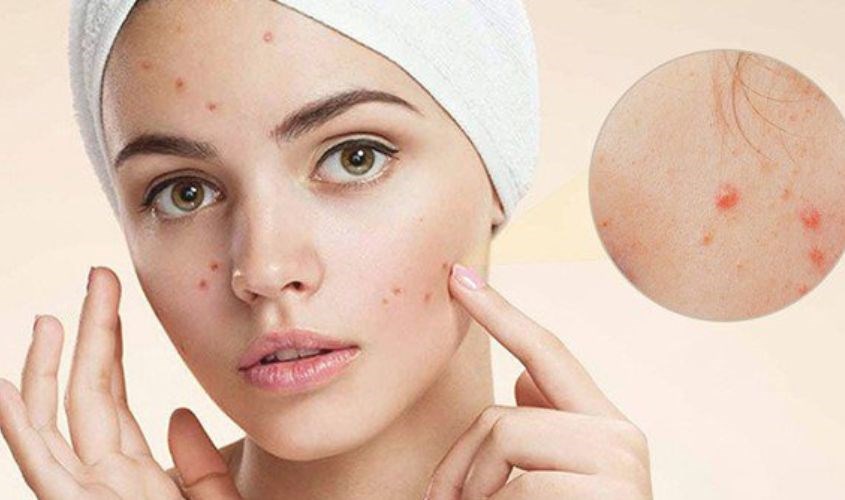 Lựa chọn kem trị mụn phù hợp để tránh tình trạng mụn nặng nề hơn Mụn ẩn sẽ được đẩy lên trên bề mặt da