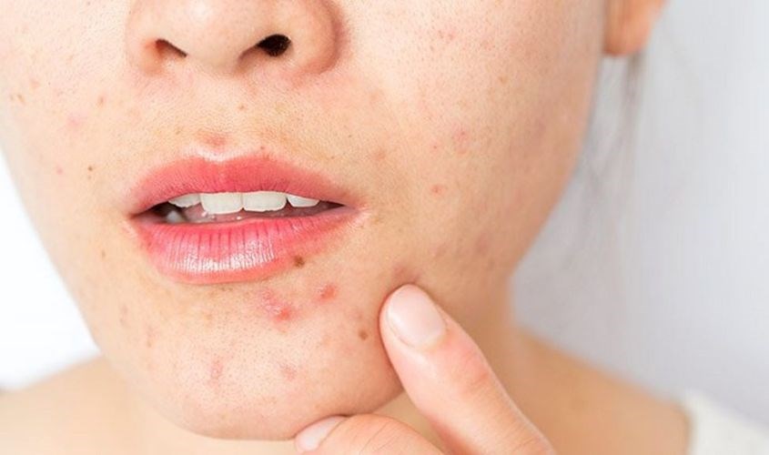 Da mụn không nên cạo lông mặt 