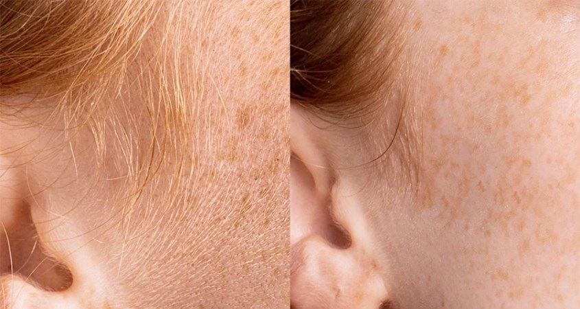 Cạo lông mặt khiến lông mọc lại nhanh và dày hơn