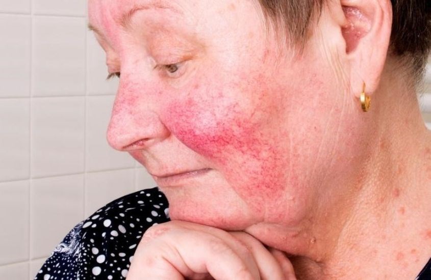 Sản phẩm chứa silicone có gây kích ứng da nghiêm trọng