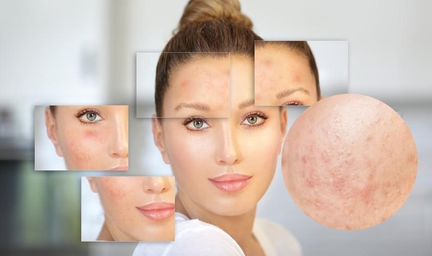 Mụn ẩn trên da do nhiều nguyên nhân gây ra